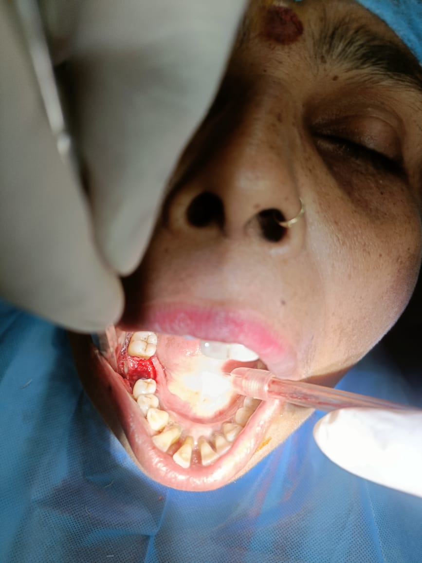 Advanced Suturing and Flap Closure Workshop