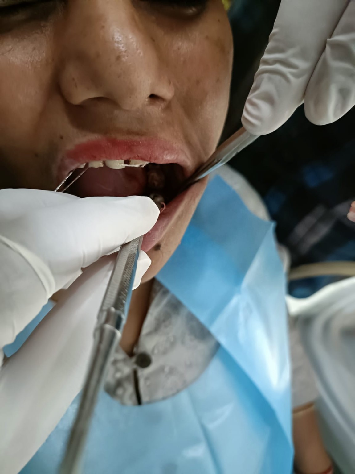 Precision Intraoral Surgical Procedure